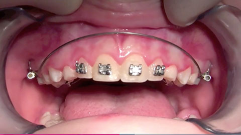 Intruding Upper Incisors: Utility Arch