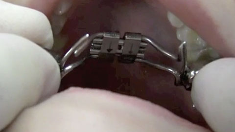 Rapid Palatal Expander